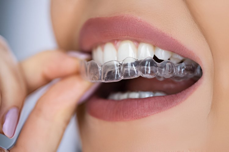 Exploring the Benefits of Invisalign with Your Local Dentist in Grants at Sundance Dental in Grants