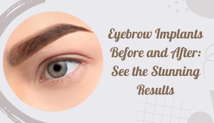 Eyebrow Implants Before and After: See the Stunning Results